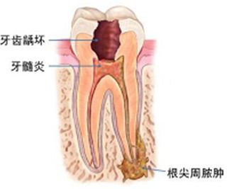 牙髓炎