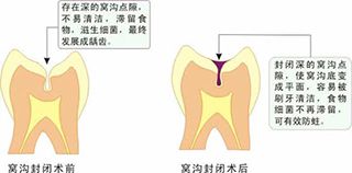 窝沟封闭