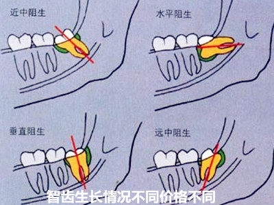 智齿生长情况不同价格不同