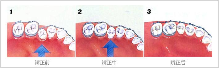 牙齿矫正的最佳时机是什么时候？